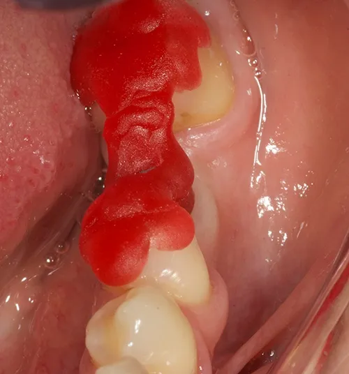 Acrylic jig used to seat permanent abutment