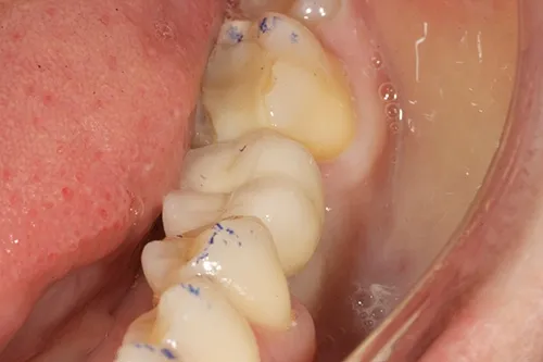 After treatment: Fitting the crown on a single implant