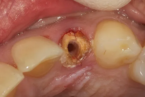 Before treatment: A single implant to replace a tooth with a split root