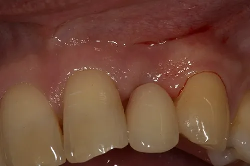 Extraction site healed