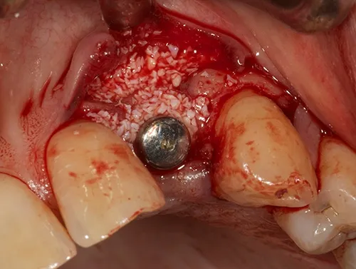Implant placement and guided bone regeneration