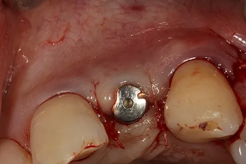Implant site closed