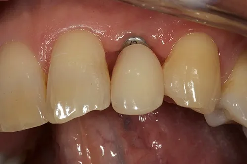 Implant placed and denture seated