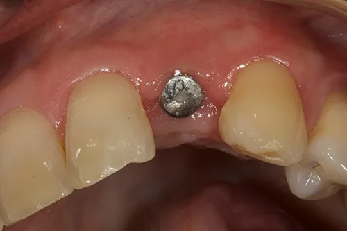Implant site healed
