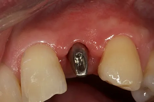 Implant abutment seated