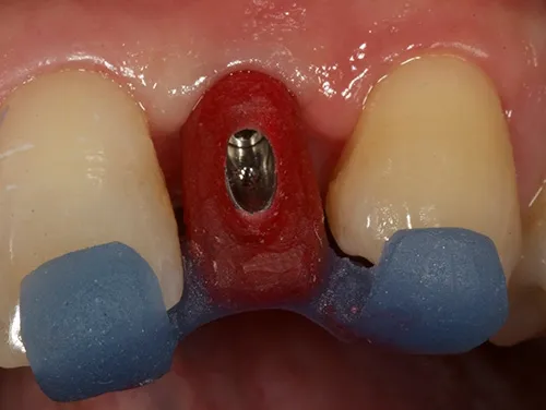 Implant abutment jig used to tighten in situ
