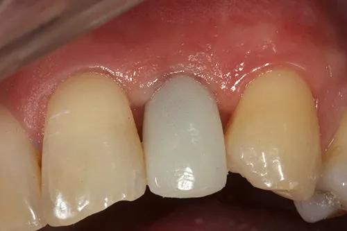 Implant temporary crown in situ
