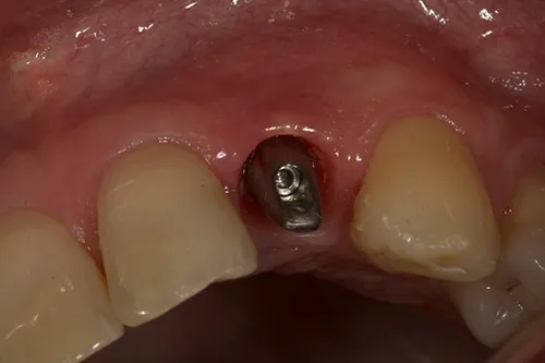 Implant abutment gum profile