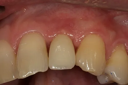 Implant crown fitted