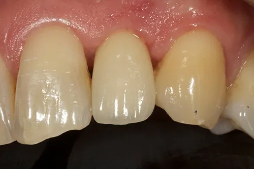 After treatment: A single implant to replace a tooth with a split root